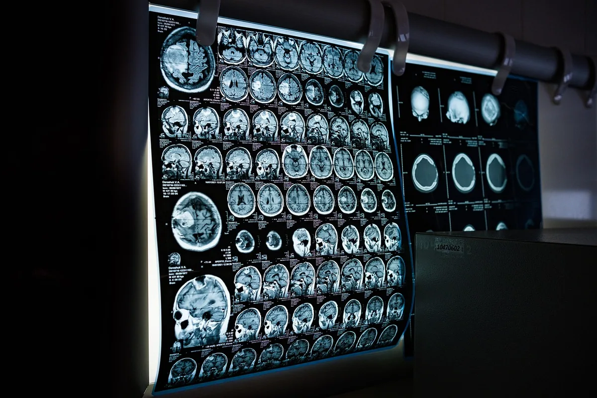 Brain Aneurysm Statistics: Key Facts and Risk Factors