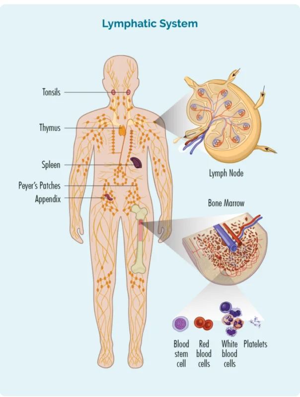 Large Cell Lymphoma: Symptoms, Causes & Treatment Guide