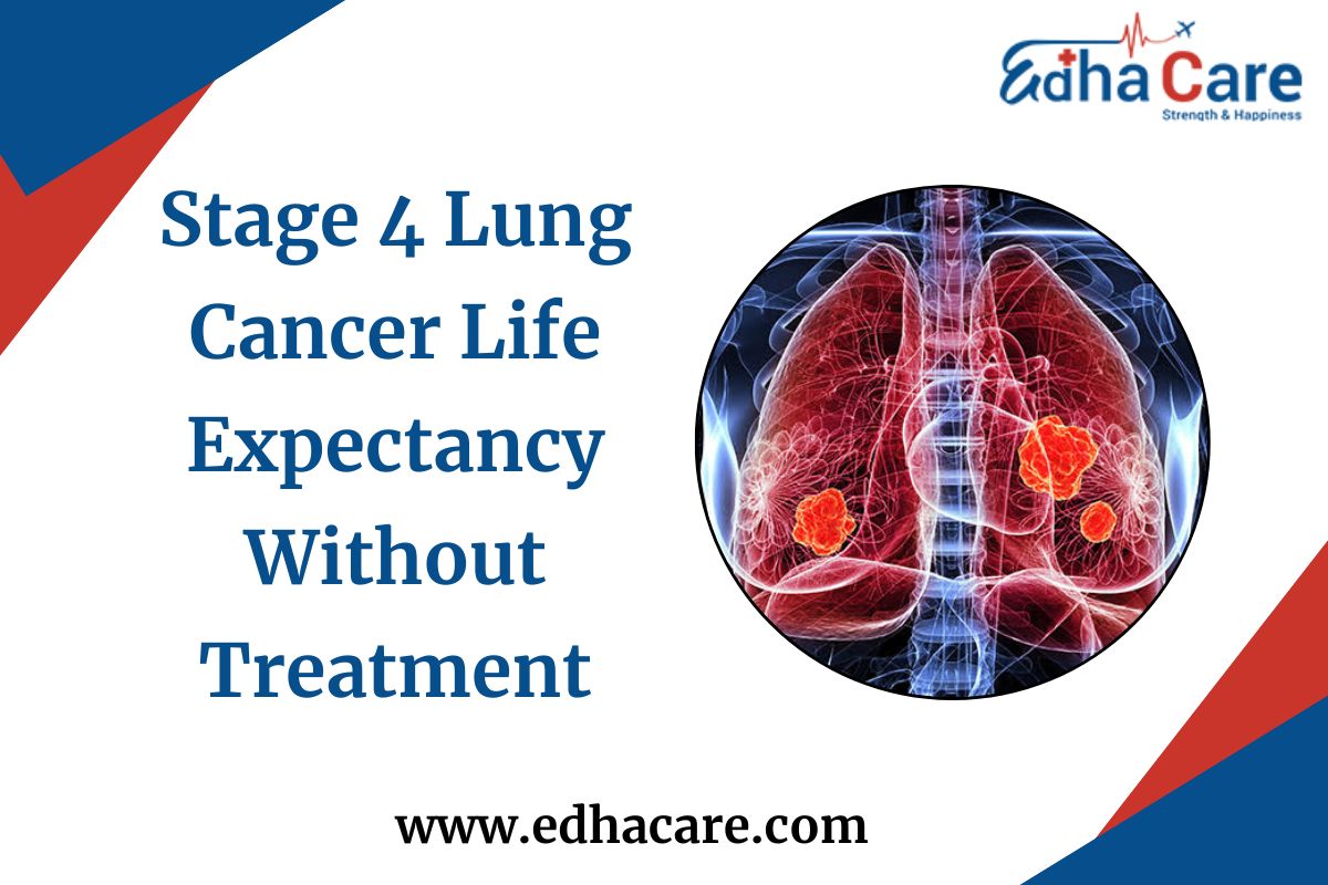 Stage 4 Lung Cancer Life Expectancy Without Treatment