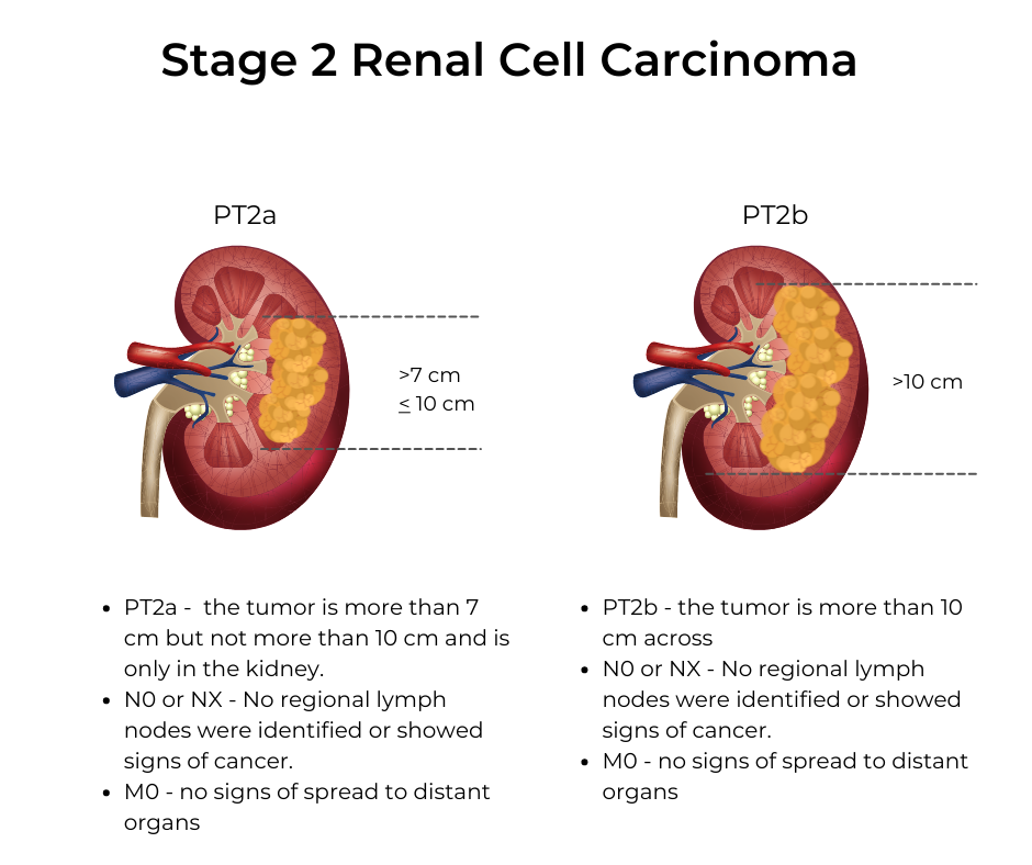 Treatment for Kidney Cancer Stage 2 – Key Facts