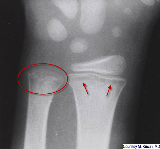 Leukemic Lines Radiology: Quick Guide for Clinicians